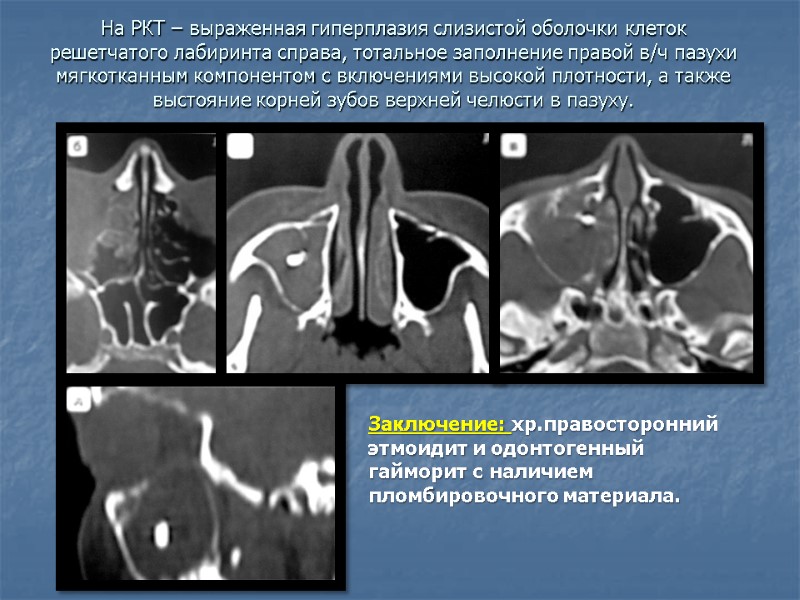 На РКТ – выраженная гиперплазия слизистой оболочки клеток решетчатого лабиринта справа, тотальное заполнение правой